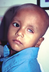 Two-year-old Yasin injured his left eye in an accident, a cornea transplant is his sole hope for  restoring his vision.
